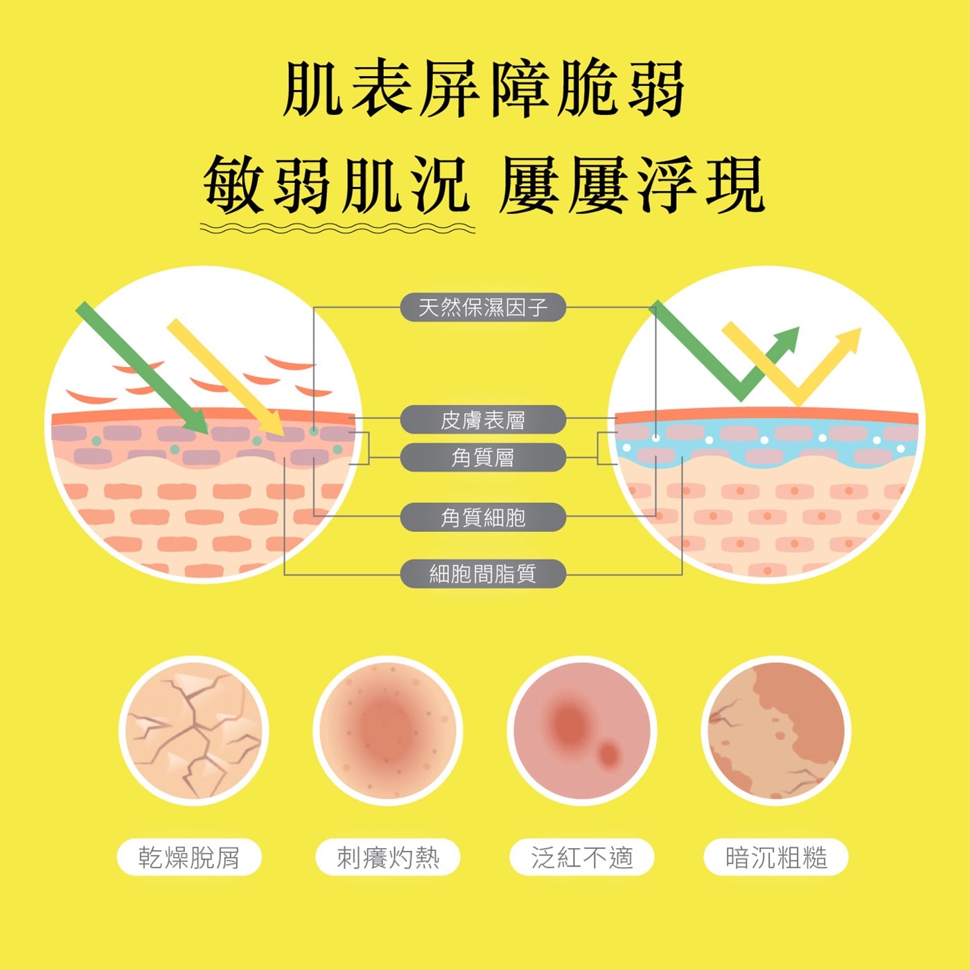 肌表屏障脆弱 敏弱肌況 屢屢浮現 天然保濕因子 皮膚表層 角質層 角質細胞 細胞間脂質 乾燥脫屑