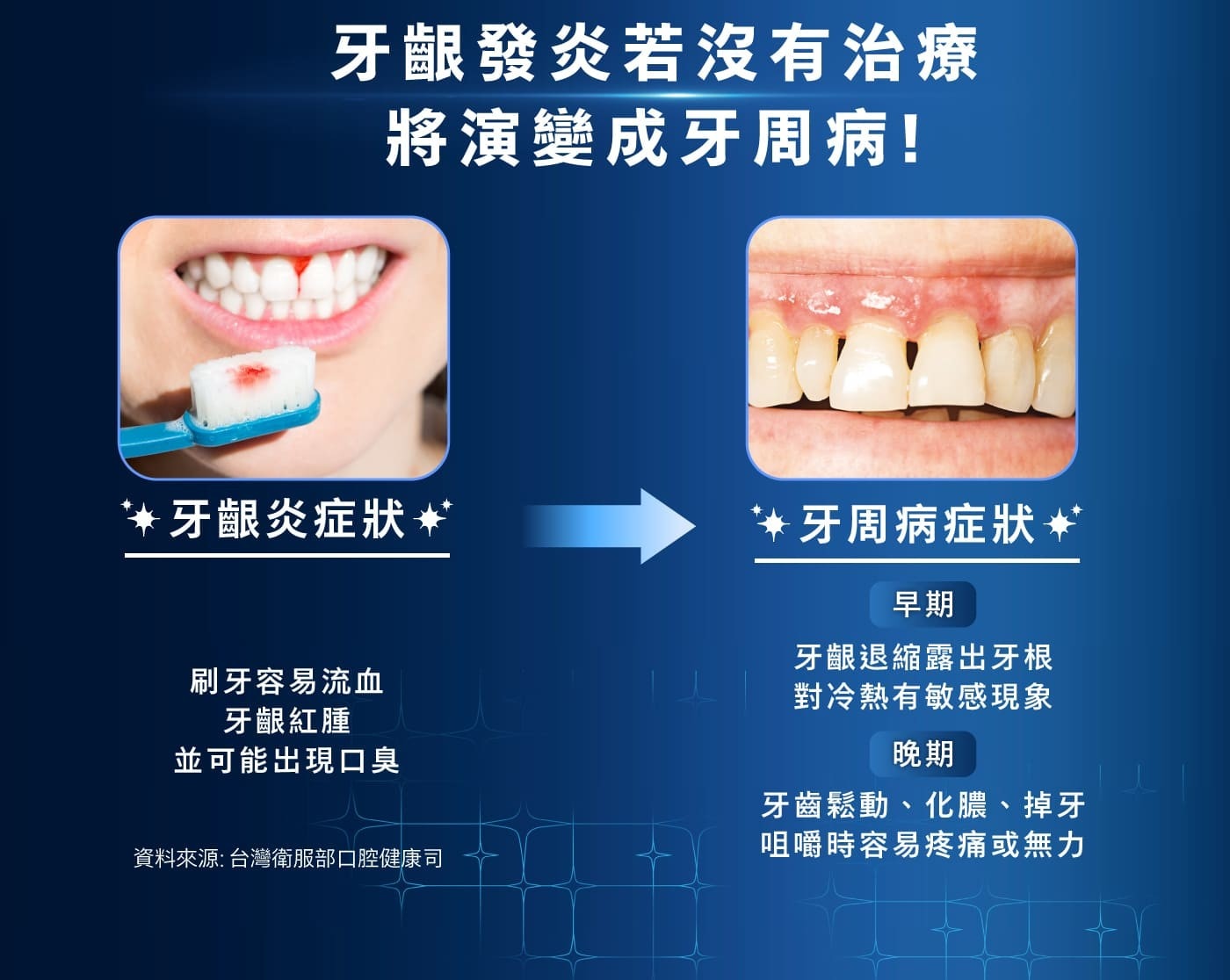 牙齦發炎若沒有治療 將演變成牙周病!