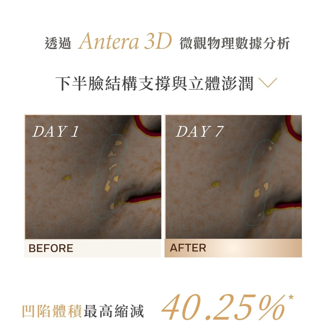 透過 Antera 3D 微觀物理數據分析下半臉結構支撐與立體澎潤V 凹陷體積最高縮減