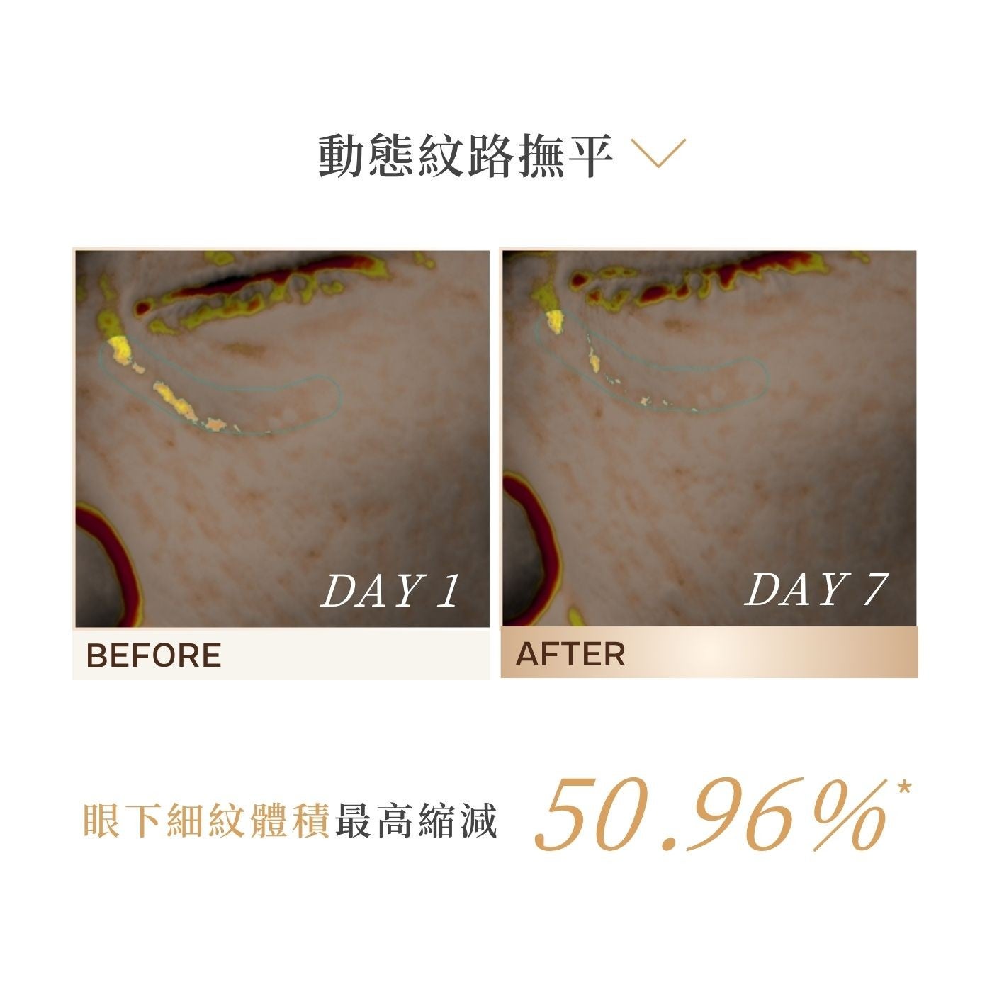 動態紋路撫平∨ 眼下細紋體積最高縮減 50.96