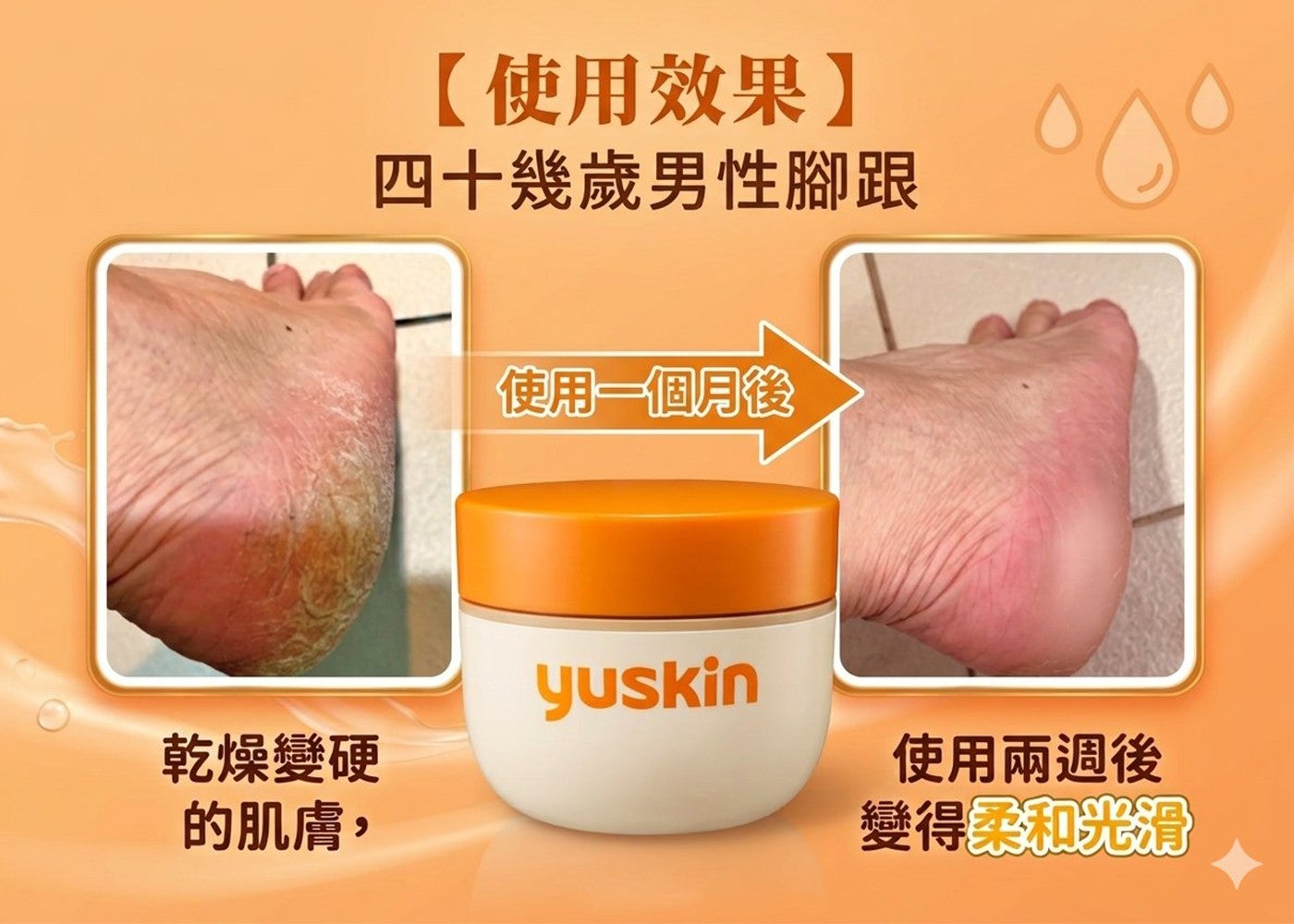 使用效果四十幾歲男性腳跟使用一個月後乾燥變硬使用兩週後的肌膚, 變得柔和光滑