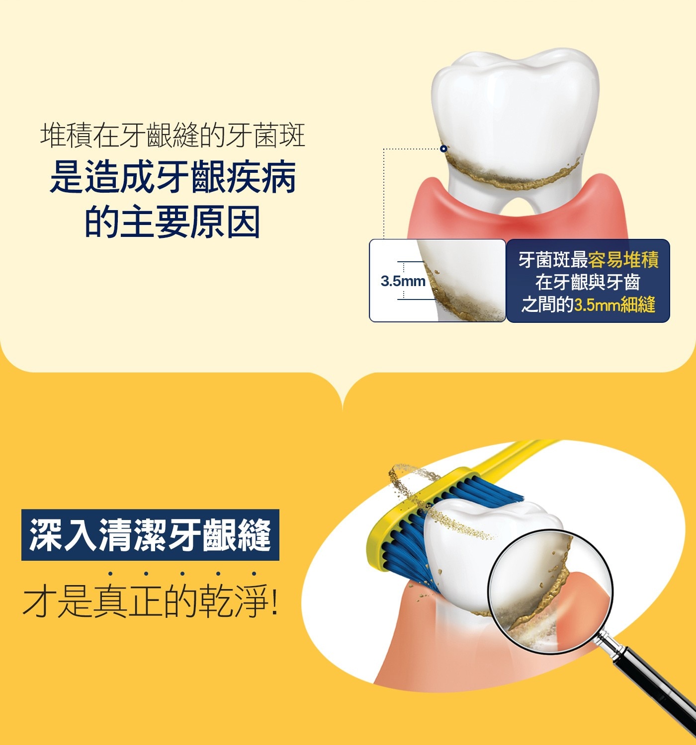 堆積在牙齦縫的牙菌斑 是造成牙齦疾病 的主要原因 牙菌斑最容易堆積 3.5mm 在牙齦與牙齒 之間的3.5mm細縫 !